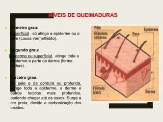 NÍVEIS DE QUEIMADURAS
Primeiro grau:
Superficial , só atinge a epiderme ou a
pele (causa vermelhidão).
Segundo grau:
Da derme ou superficial, atinge toda a
epiderme e parte da derme (forma
bolhas).
Terceiro grau:
Da pele e da gordura ou profunda,
atinge toda a epiderme, a derme e
outros tecidos mais profundos,
podendo chegar até os ossos. Surge a
cor preta, devido a carbonização dos
tecidos.
 