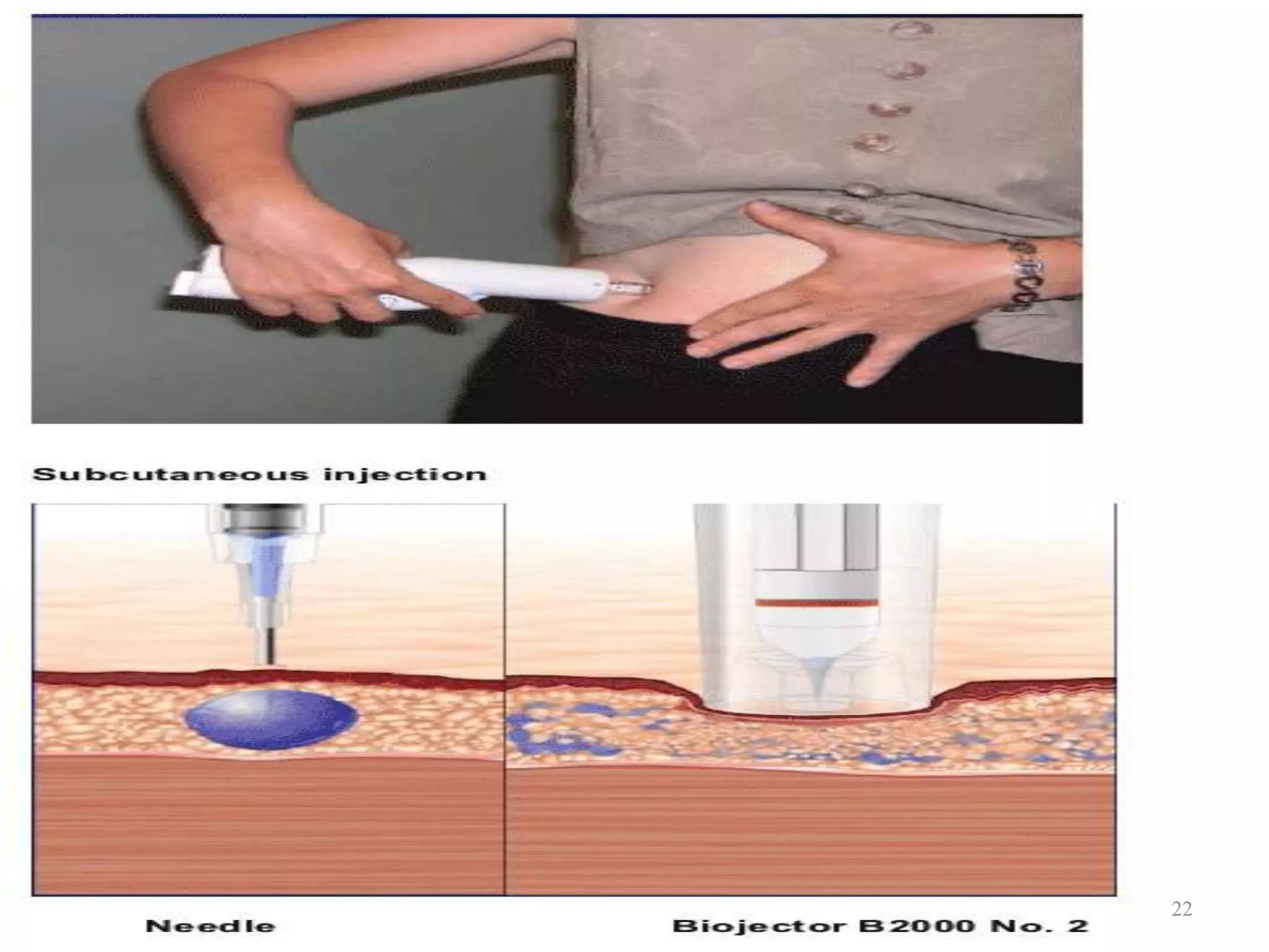 Routes of parenteral administration | PPTX