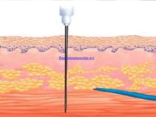 Routes of parenteral administration | PPTX