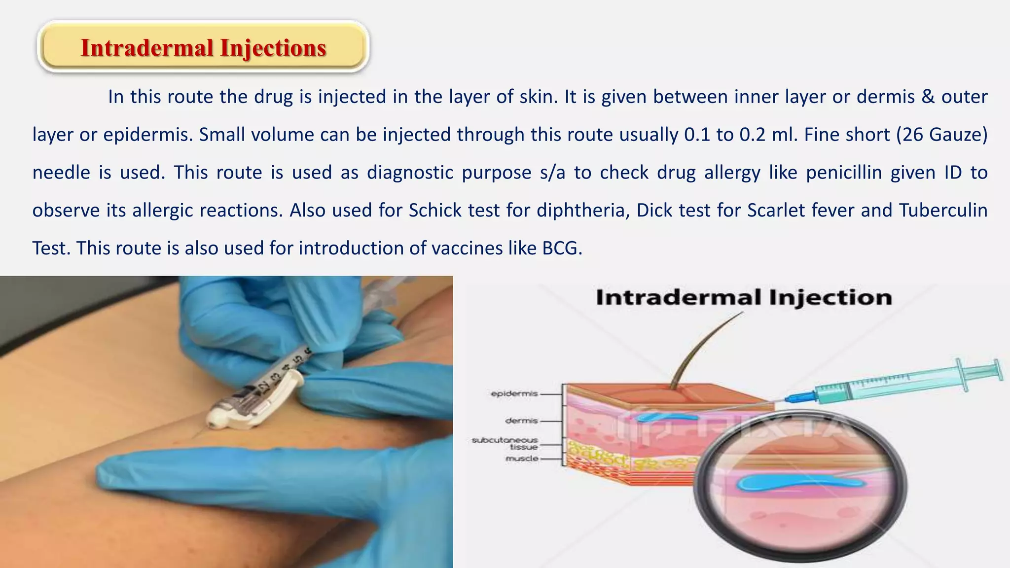 Intradermal Injections
In this route the drug is injected in the layer of skin. It is given between inner layer or dermis & outer
layer or epidermis. Small volume can be injected through this route usually 0.1 to 0.2 ml. Fine short (26 Gauze)
needle is used. This route is used as diagnostic purpose s/a to check drug allergy like penicillin given ID to
observe its allergic reactions. Also used for Schick test for diphtheria, Dick test for Scarlet fever and Tuberculin
Test. This route is also used for introduction of vaccines like BCG.
 