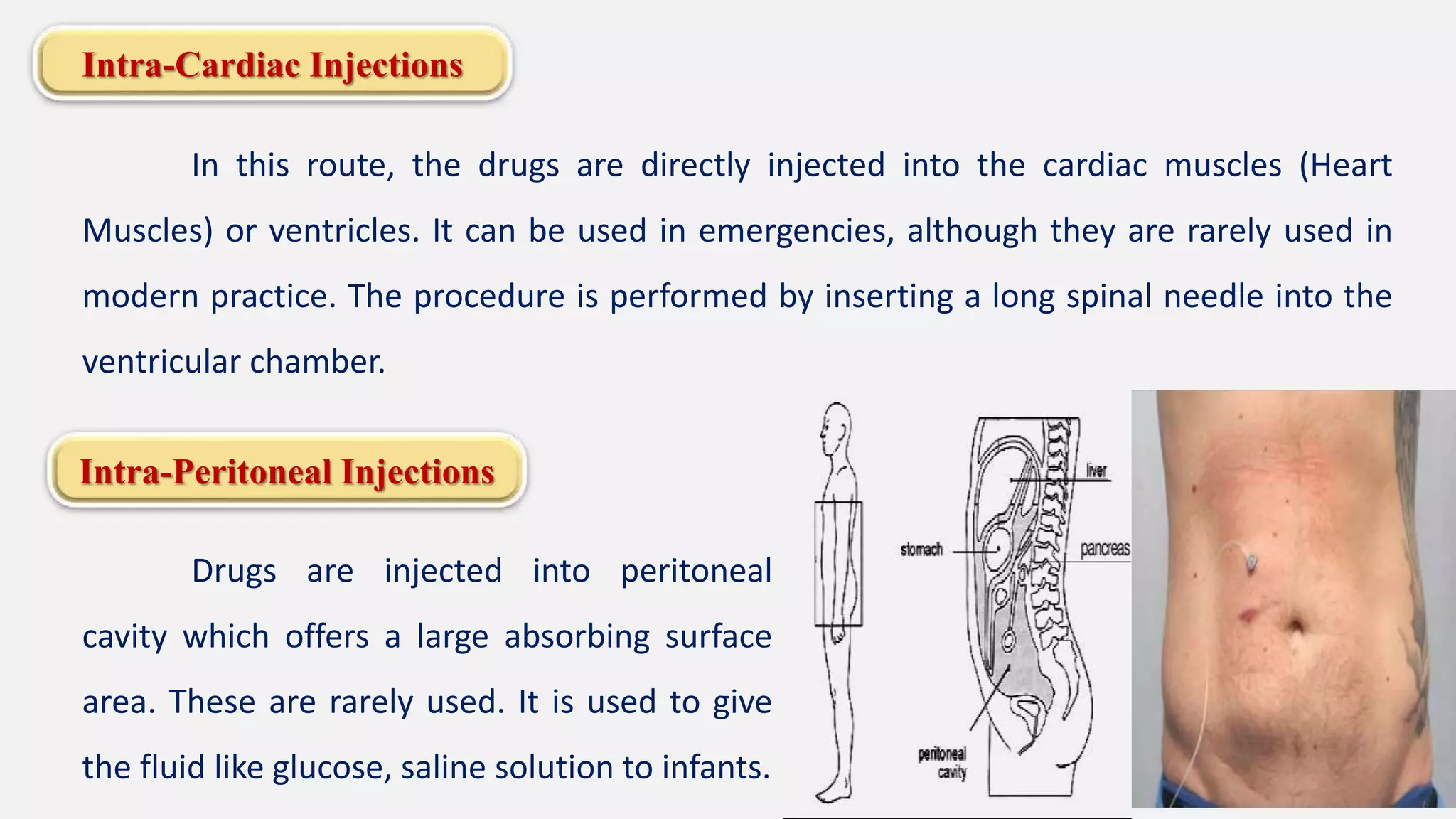Intra-Cardiac Injections
In this route, the drugs are directly injected into the cardiac muscles (Heart
Muscles) or ventricles. It can be used in emergencies, although they are rarely used in
modern practice. The procedure is performed by inserting a long spinal needle into the
ventricular chamber.
Intra-Peritoneal Injections
Drugs are injected into peritoneal
cavity which offers a large absorbing surface
area. These are rarely used. It is used to give
the fluid like glucose, saline solution to infants.
 