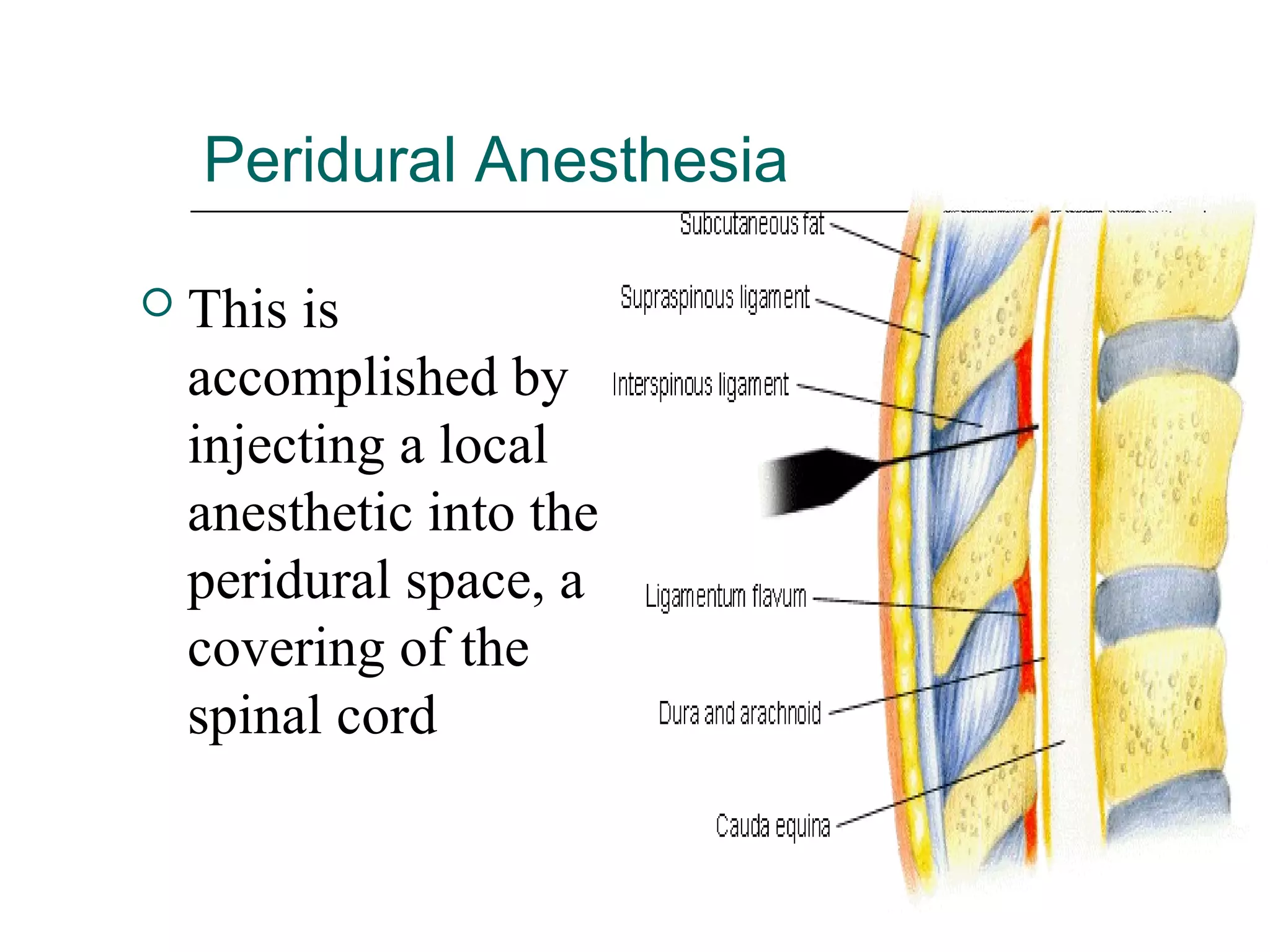 Peridural Anesthesia


This is
accomplished by
injecting a local
anesthetic into the
peridural space, a
covering of the
spinal cord

 