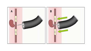 ROUTINE BRONCHOSCOPIC SAMPLING TECHNIQUES -part 2.pptx