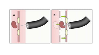 ROUTINE BRONCHOSCOPIC SAMPLING TECHNIQUES -part 2.pptx
