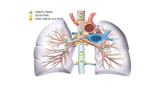 ROUTINE BRONCHOSCOPIC SAMPLING TECHNIQUES -part 2.pptx