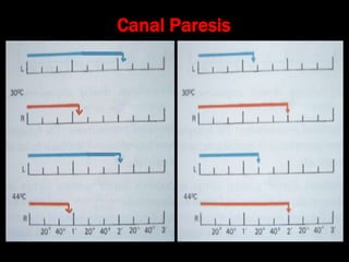 Canal Paresis
 