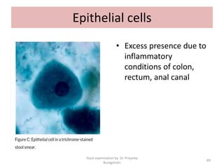 Epithelial cells
• Excess presence due to
inflammatory
conditions of colon,
rectum, anal canal
Stool examination by Dr. Priyanka
Buragohain
69
 