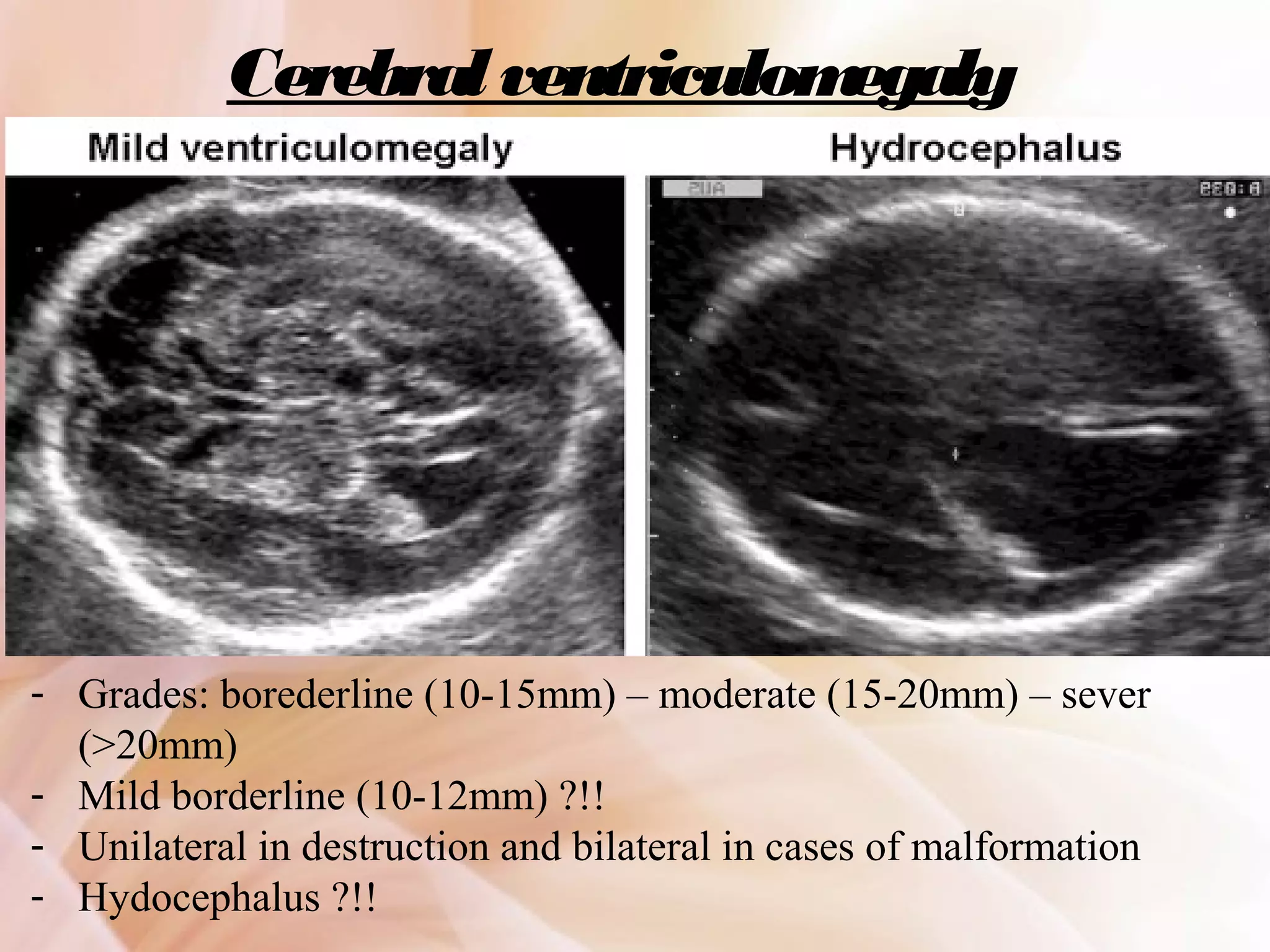 Routine fetal anatomy scan at 18-23 weeks | PPT