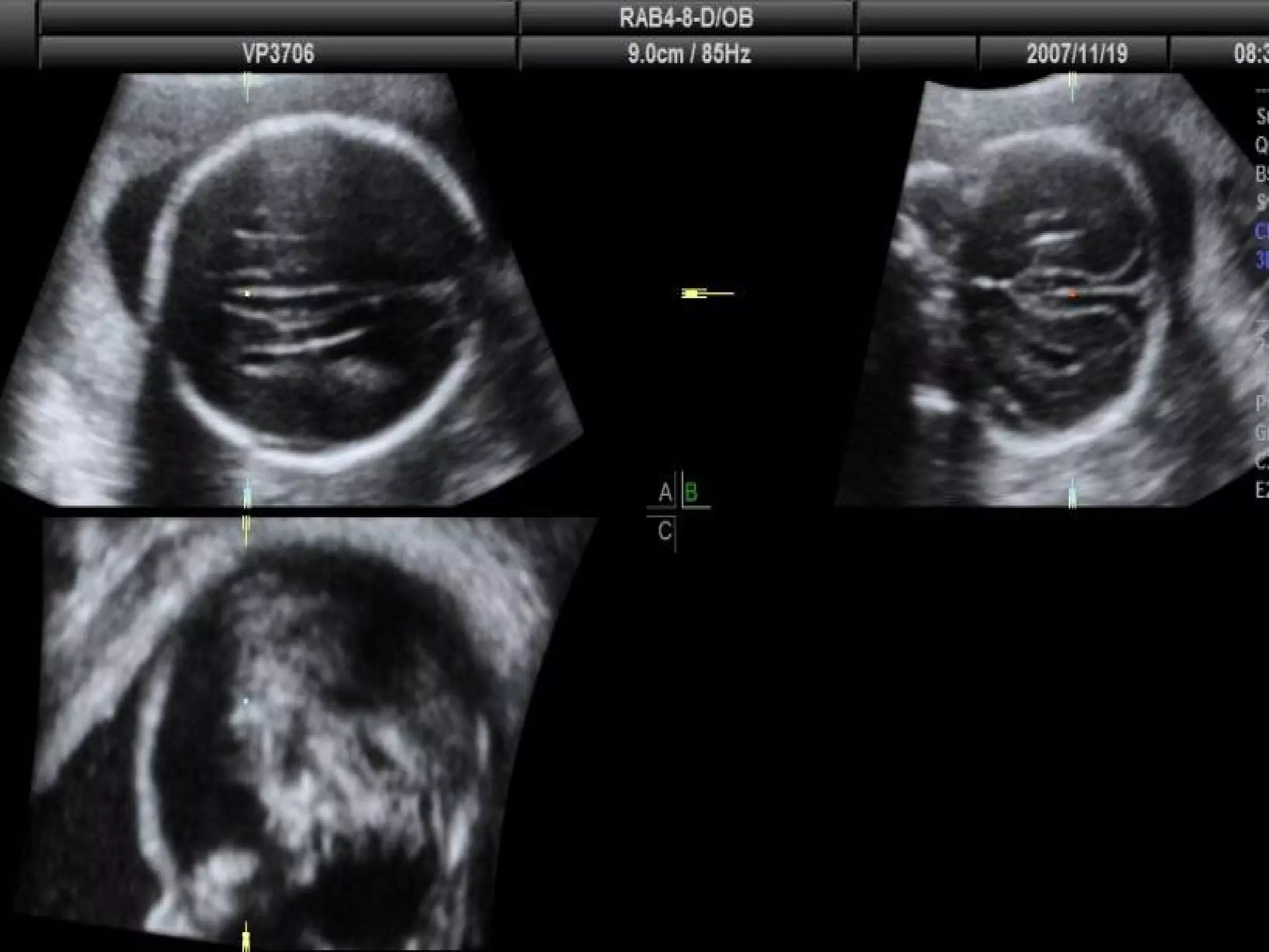 Routine fetal anatomy scan at 18-23 weeks | PPT