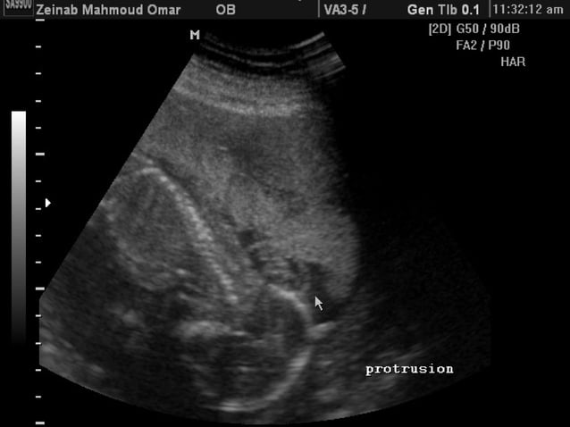 Routine fetal anatomy scan at 18-23 weeks | PPT | Pregnancy ...