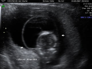 Routine fetal anatomy scan at 18-23 weeks | PPT