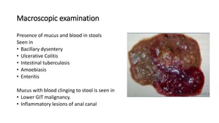 Macroscopic examination
Presence of mucus and blood in stools
Seen in
• Bacillary dysentery
• Ulcerative Colitis
• Intestinal tuberculosis
• Amoebiasis
• Enteritis
Mucus with blood clinging to stool is seen in
• Lower GIT malignancy.
• Inflammatory lesions of anal canal
 