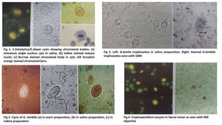 Fig 1. E.histolytica/E.dispar cysts showing chromatoid bodies; (a)
immature single nucleus cyst in saline, (b) Iodine stained mature
nuclei, (c) Burrow stained chromatoid body in cyst, left Acrydine
orange stained chromatoid bars.
Fig 2. Left: G.lamlia trophozoites in saline preparation, Right: Stained G.lamblia
trophozoites seen with 100X
Fig 4. Cryptosporidium oocysts in faecal smear as seen with 40X
objective
Fig 3. Cysts of G. lamblia (a) In eosin preparation, (b) In saline preparation, (c) In
iodine preparation
 
