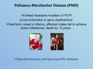 Pelizaeus-Merzbacher Disease (PMD) <ul><li>X-linked recessive mutation of  PLP1 </li></ul><ul><li>(Loss-of-function or gen...