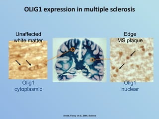 OLIG1 expression in multiple sclerosis Olig1 nuclear Olig1 cytoplasmic Unaffected white matter Edge MS plaque Arnett, Fanc...