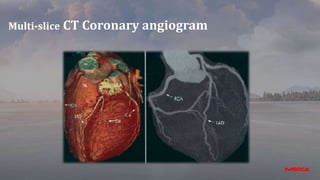 Multi-slice CT Coronary angiogram
 