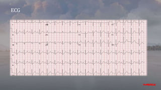 ECG
 