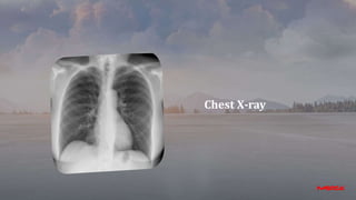 Chest X-ray
 