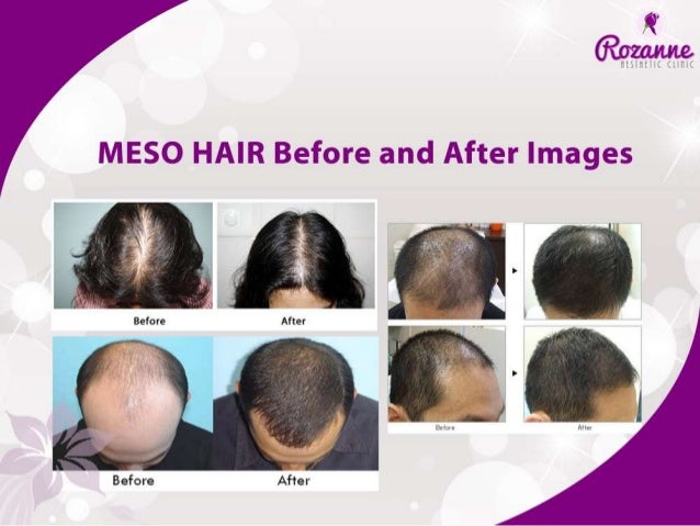 All about Mesotherapy