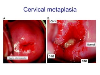 Cervical metaplasia
 