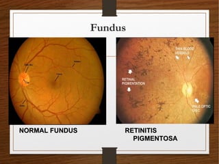 Fundus
NORMAL FUNDUSNORMAL FUNDUS RETINITISRETINITIS
PIGMENTOSAPIGMENTOSA
 