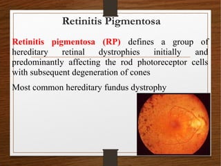 Retinitis pigmentosa (RP) defines a group of
hereditary retinal dystrophies initially and
predominantly affecting the rod photoreceptor cells
with subsequent degeneration of cones
Most common hereditary fundus dystrophy
Retinitis Pigmentosa
 