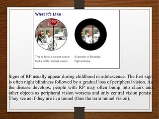 Signs of RP usually appear during childhood or adolescence. The first sign
is often night blindness followed by a gradual loss of peripheral vision. As
the disease develops, people with RP may often bump into chairs and
other objects as peripheral vision worsens and only central vision persist.
They see as if they are in a tunnel (thus the term tunnel vision).
 