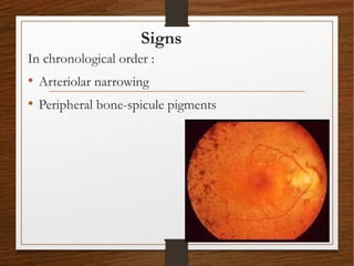 Signs
In chronological order :
• Arteriolar narrowing
• Peripheral bone-spicule pigments
 