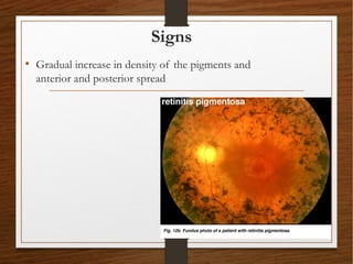 Signs
• Gradual increase in density of the pigments and
anterior and posterior spread
 
