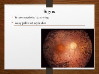 Signs
• Severe arteriolar narrowing
• Waxy pallor of optic disc
 