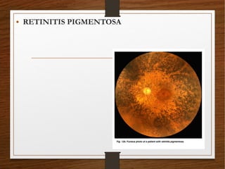 • RETINITIS PIGMENTOSA
 