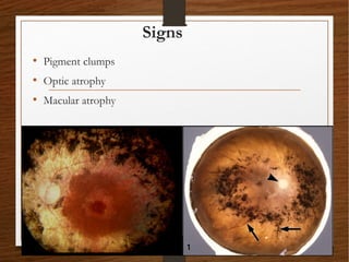 Signs
• Pigment clumps
• Optic atrophy
• Macular atrophy
 