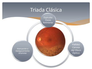 Triada Clásica
Espículas
Oseas
Retinianas
Palidez
Cerosa
del Disco
Óptico
Atenuación o
Adelgazamiento
Arteriolar
 