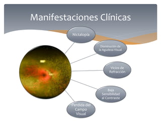 Nictalopía
Perdida del
Campo
Visual
Disminución de
la Agudeza Visual
Vicios de
Refracción
Baja
Sensibilidad
al Contraste
Manifestaciones Clínicas
 