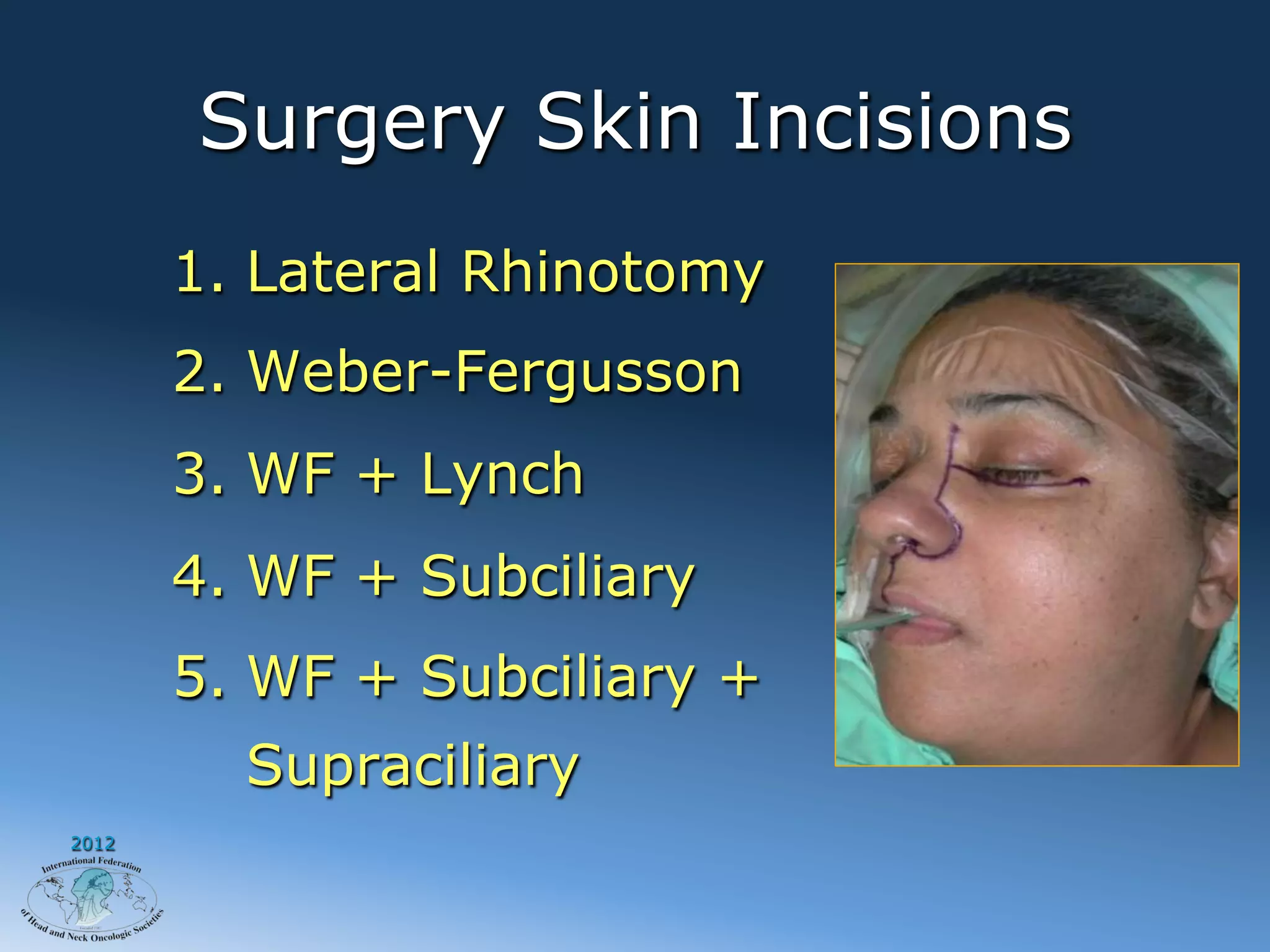 Surgery Skin Incisions
       1.  Lateral Rhinotomy
       2.  Weber-Fergusson
       3.  WF + Lynch
       4.  WF + Subciliary
       5.  WF + Subciliary +
         Supraciliary
2012
 