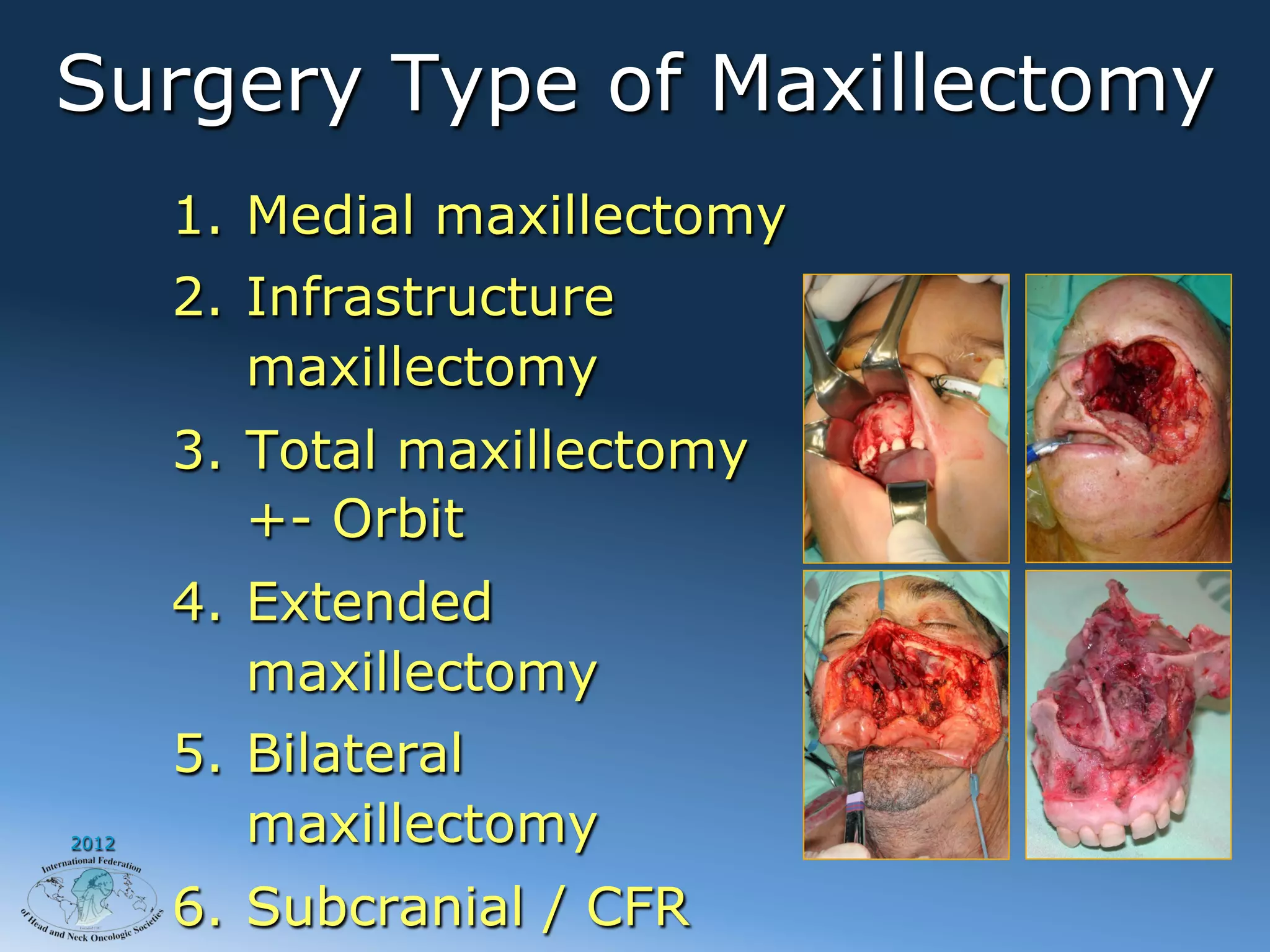 Surgery Type of Maxillectomy
       1.  Medial maxillectomy
       2.  Infrastructure
           maxillectomy
       3.  Total maxillectomy
           +- Orbit
       4.  Extended
           maxillectomy
       5.  Bilateral
2012       maxillectomy
       6.  Subcranial / CFR
 