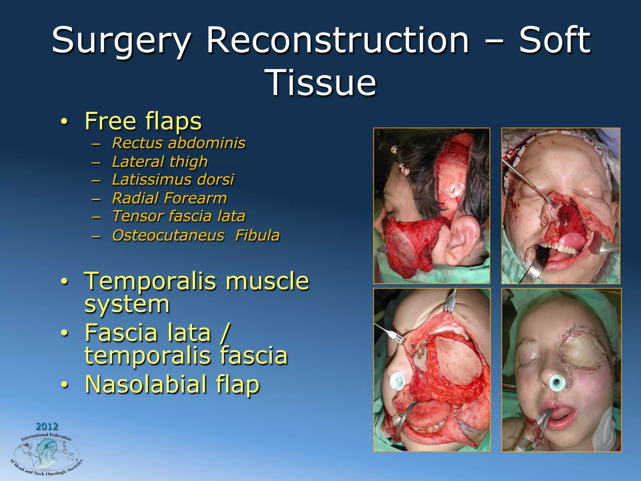 Surgery Reconstruction – Soft
             Tissue
       •  Free flaps
         –    Rectus abdominis
         –    Lateral thigh
         –    Latissimus dorsi
         –    Radial Forearm
         –    Tensor fascia lata
         –    Osteocutaneus Fibula


       •  Temporalis muscle
          system
       •  Fascia lata /
          temporalis fascia
       •  Nasolabial flap
2012
 