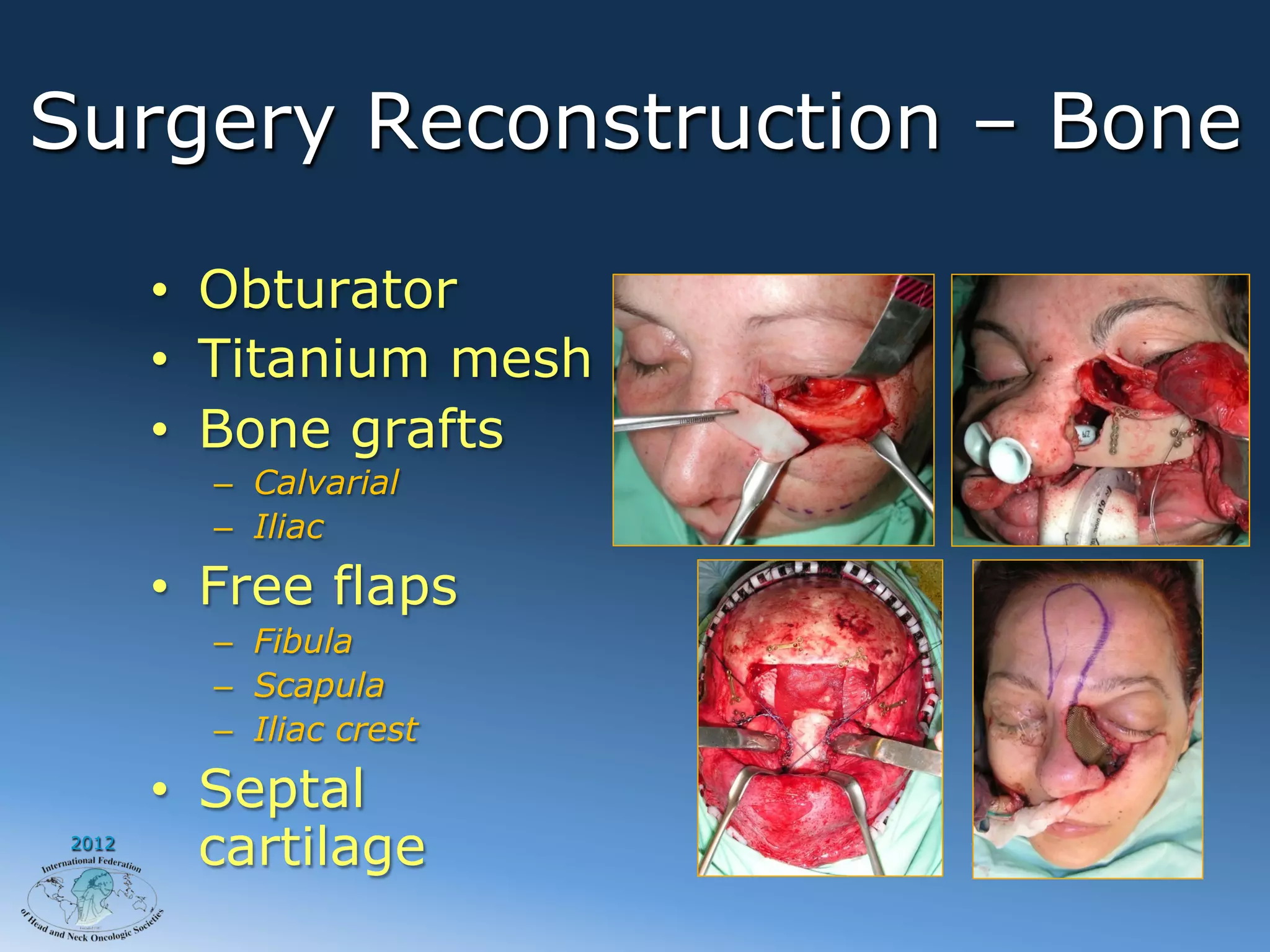 Surgery Reconstruction – Bone

        •  Obturator
        •  Titanium mesh
        •  Bone grafts
          –  Calvarial
          –  Iliac
        •  Free flaps
          –  Fibula
          –  Scapula
          –  Iliac crest
        •  Septal
 2012
           cartilage
 