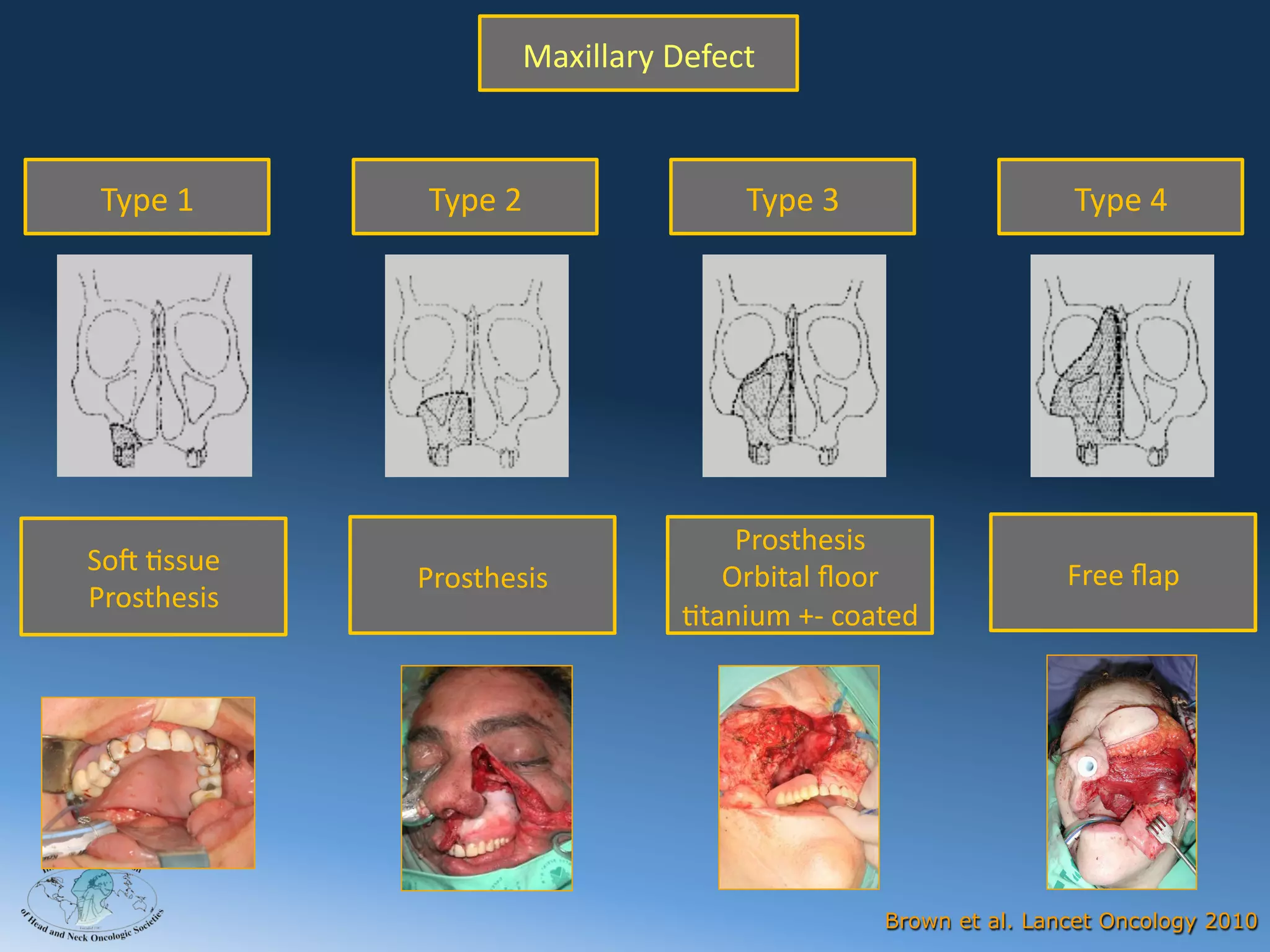 Maxillary	
  Defect



  Type	
  1         Type	
  2                      Type	
  3                      Type	
  4




                                                 Prosthesis	
  
 So@	
  Assue	
                                                                   Free	
  ﬂap	
  
                    Prosthesis                  Orbital	
  ﬂoor	
  
 Prosthesis
                                             Atanium	
  +-­‐	
  coated




2012



                                                                  Brown et al. Lancet Oncology 2010
 
