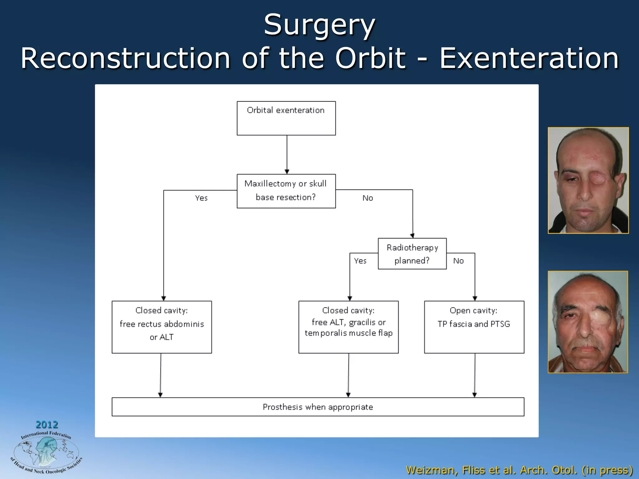 Surgery
Reconstruction of the Orbit - Exenteration




 2012




                           Weizman, Fliss et al. Arch. Otol. (in press)
 