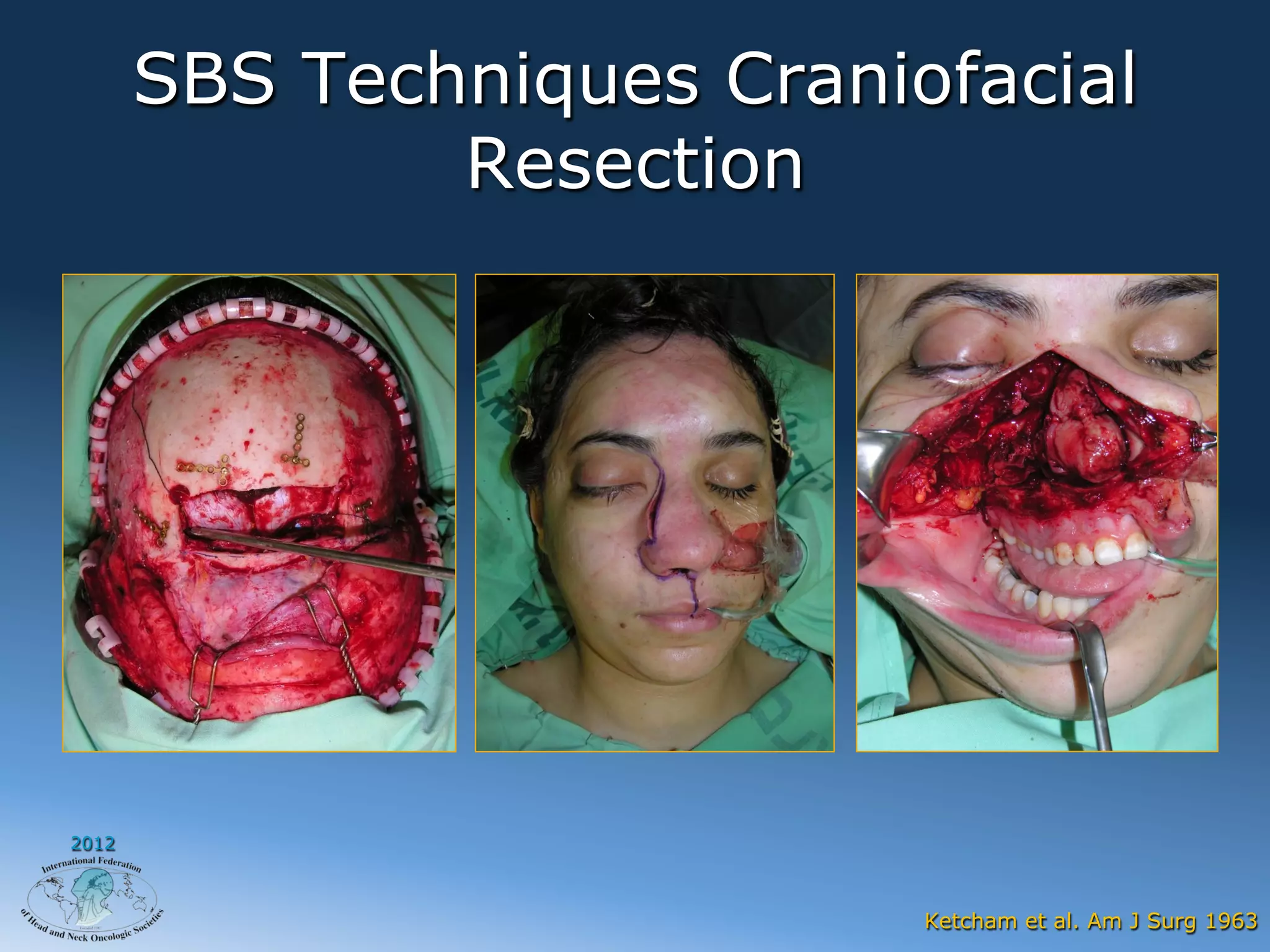 SBS Techniques Craniofacial
               Resection




2012



                            Ketcham et al. Am J Surg 1963
 