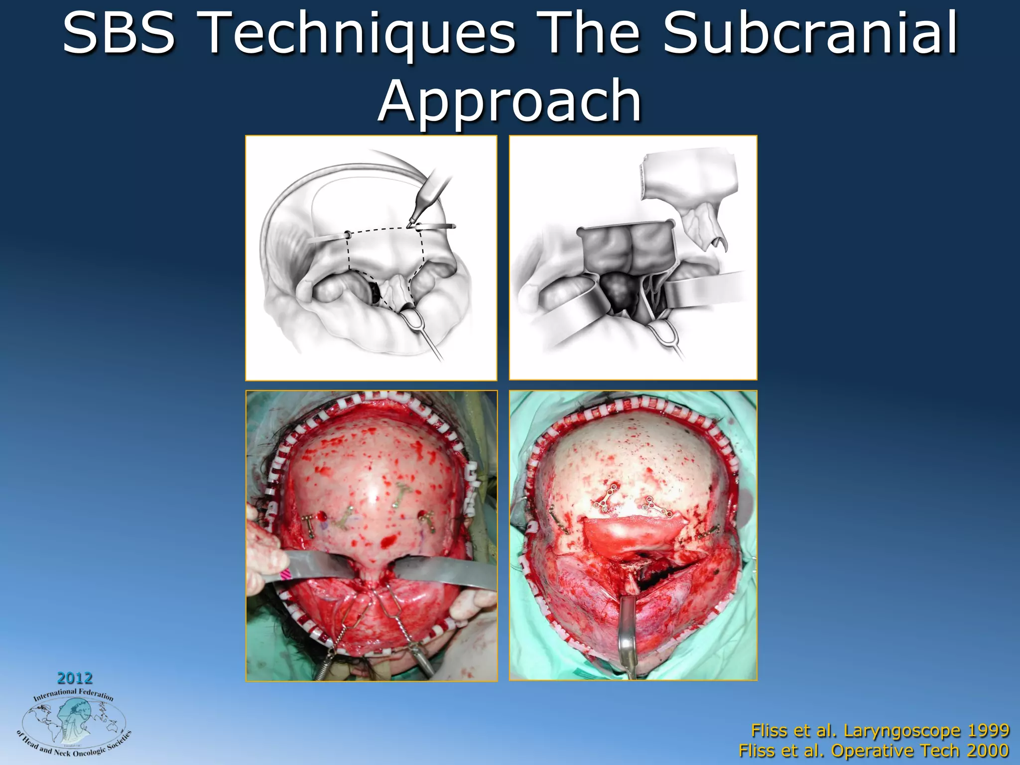 SBS Techniques The Subcranial
          Approach




2012


                       Fliss et al. Laryngoscope 1999
                     Fliss et al. Operative Tech 2000
 