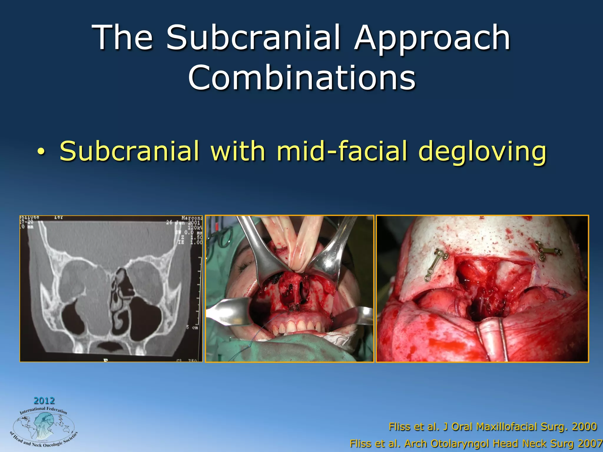 The Subcranial Approach
            Combinations

•  Subcranial with mid-facial degloving




2012


                              Fliss et al. J Oral Maxillofacial Surg. 2000
                       Fliss et al. Arch Otolaryngol Head Neck Surg 2007
 