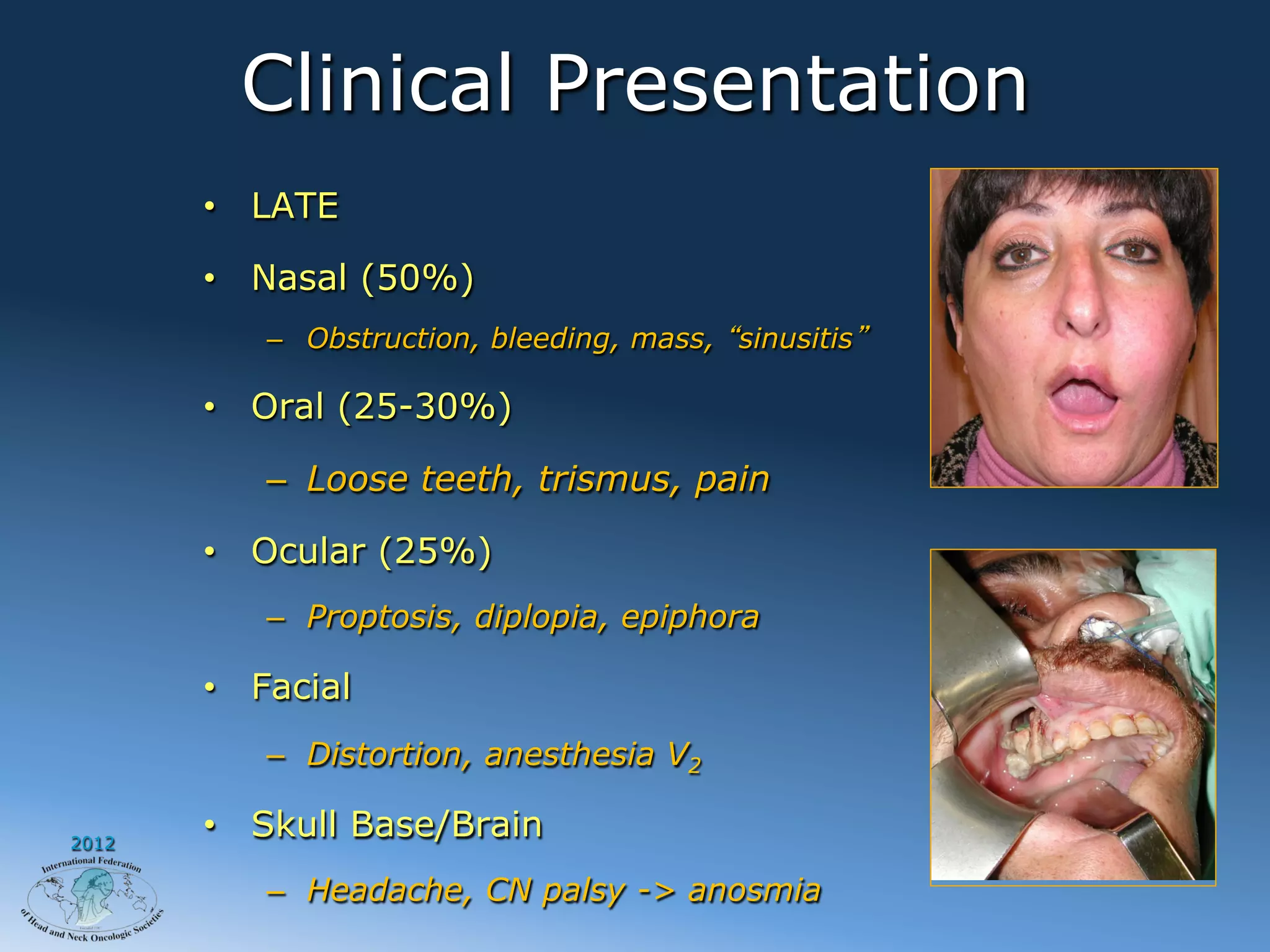 Clinical Presentation
       •  LATE

       •  Nasal (50%)
          –  Obstruction, bleeding, mass, sinusitis

       •  Oral (25-30%)

          –  Loose teeth, trismus, pain

       •  Ocular (25%)
          –  Proptosis, diplopia, epiphora

       •  Facial
          –  Distortion, anesthesia V2

2012
       •  Skull Base/Brain
          –  Headache, CN palsy -> anosmia
 