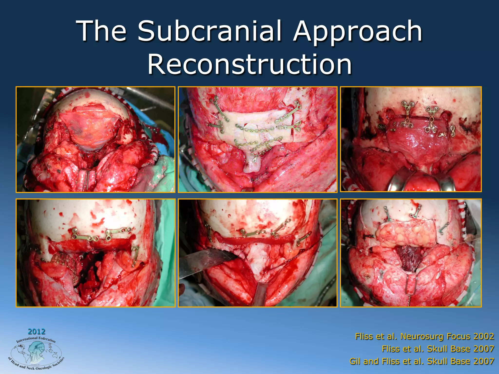 The Subcranial Approach
            Reconstruction




2012
                          Fliss et al. Neurosurg Focus 2002
                                 Fliss et al. Skull Base 2007
                         Gil and Fliss et al. Skull Base 2007
 