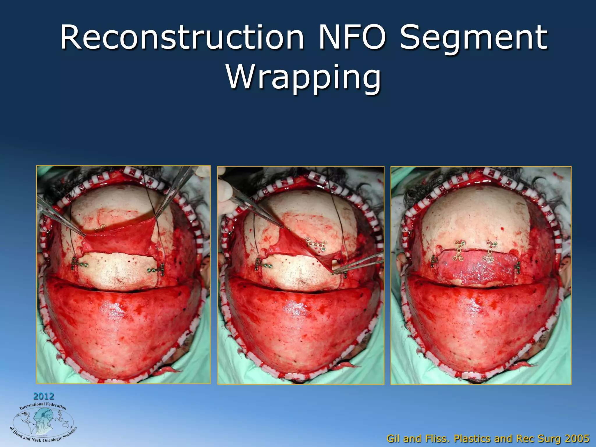 Reconstruction NFO Segment
                Wrapping




2012




                        Gil and Fliss. Plastics and Rec Surg 2005
 