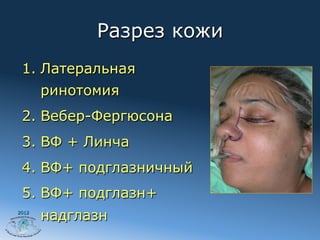 Разрез кожи
 1.  Латеральная
       ринотомия
 2.  Вебер-Фергюсона
 3.  ВФ + Линча
 4.  ВФ+ подглазничный
 5.  ВФ+ подглазн+
2012
       надглазн
 