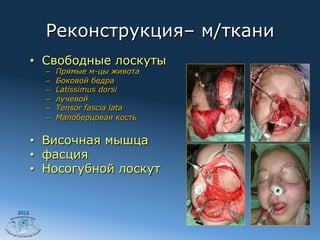 Реконструкция– м/ткани
       •  Свободные лоскуты
         –    Прямые м-цы живота
         –    Боковой бедра
         –    Latissimus dorsi
         –    лучевой
         –    Tensor fascia lata
         –    Малоберцовая кость


       •  Височная мышца
       •  фасция
       •  Носогубной лоскут


2012
 