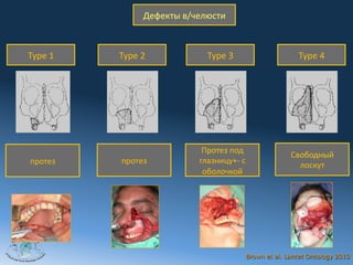 Дефекты	
  в/челюсти



  Type	
  1   Type	
  2               Type	
  3                        Type	
  4




                                    Протез	
  под	
  
                                                                     Свободный	
  
   протез     протез               глазницу+-­‐	
  с	
  
                                                                       лоскут	
  
                                    оболочкой




2012



                                                       Brown et al. Lancet Oncology 2010
 