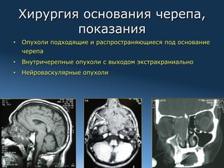Хирургия основания черепа,
           показания
•  Опухоли подходящие и распространяющиеся под основание
       черепа
•  Внутричерепные опухоли с выходом экстракраниально
•  Нейроваскулярные опухоли




2012
 